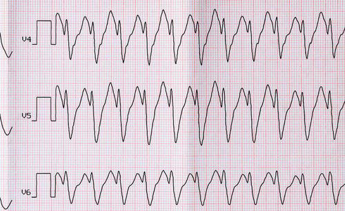 冠心病的心电图特征是什么