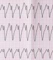 冠心病的心电图特征是什么